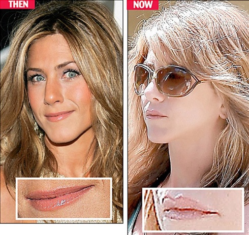 Celebrity cosmetic surgery: Jennifer Aniston